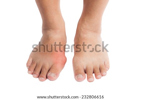 Pair of feet with deformed right toe due to painful gout inflammation.