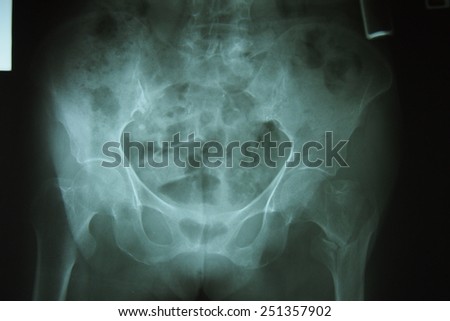 Film x-ray pelvis - stock photo