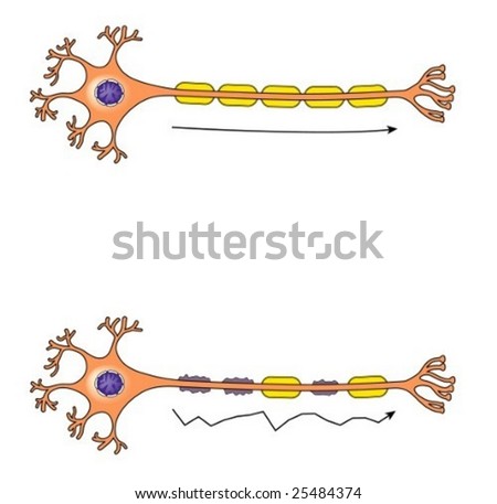 examining guillain barre syndrome Treatment with trastuzumab was complicated by the development of guillain‑ barré syndrome, well documented by emg examination, cerebrospinal fluid. examining guillain barre syndrome Treatment with trastuzumab was complicated by the development of guillain‑ barré syndrome, well documented by emg examination, cerebrospinal fluid.