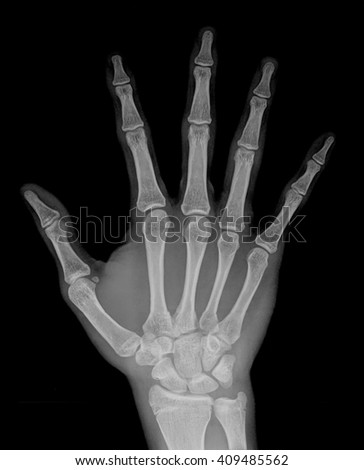 Wrist Hand Xrays Image Show Fracture Stock Photo 120751912 - Shutterstock