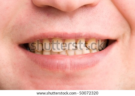 dating a guy with yellow teeth Sickening moment dentist finds dozens of live maggots wriggling between patient’s teeth disgusting moment man 'poos on woman's doorstep before she chases him off'. dating a guy with yellow teeth Sickening moment dentist finds dozens of live maggots wriggling between patient’s teeth disgusting moment man 'poos on woman's doorstep before she chases him off'.