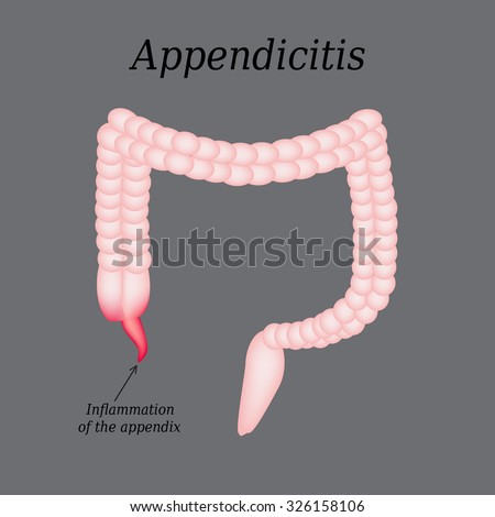 Appendicitis Stock Photos, Images, & Pictures 