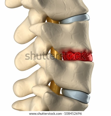 Stock Images similar to ID 194424284 - stages to a disc herniation.... - 웹