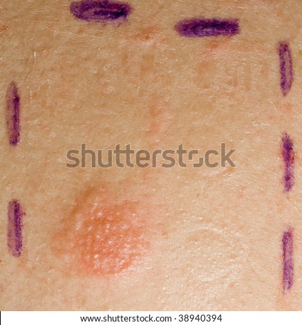 Patch Testing For Skin Allergies Used