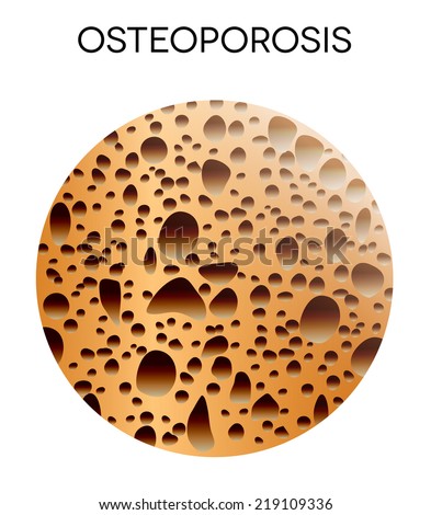 Essay about osteoporosis
