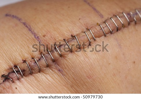 stock images similar to id 108133865 stitches on arm after stock images similar to id 108133865 stitches on arm after stock images similar to id 108133865 stitches on arm after stock images similar to id 108133865 stitches on arm after