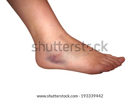 ankle leg swelling bruised joint tripping twisting right shutterstock foot edema arthritis cancer middle finger left vector painful bite