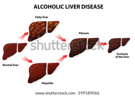 Alcoholism is a disease essay