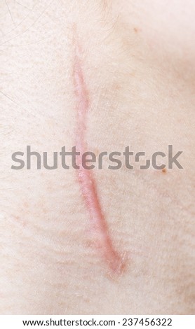 stock images similar to id 108133865 stitches on arm after stock images similar to id 108133865 stitches on arm after stock images similar to id 108133865 stitches on arm after stock images similar to id 108133865 stitches on arm after