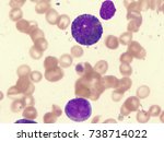 Small photo of Acute myelocytic leukemia (AML), M2 eosinophilic subtype