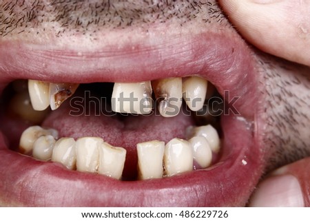 Bad teeth oral sex pictures