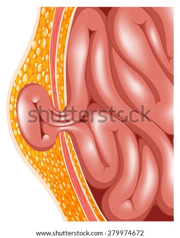 Hernia Stock Images, RoyaltyFree Images  Vectors  Shutterstock