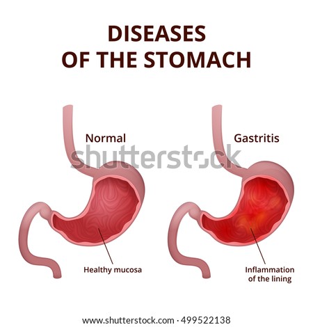 Anatomy Human Healthy Unhealthy Stomach Medical Stock Vector 499522138 ...