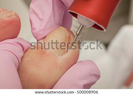 Điều trị bàn chân Doctor Loại bỏ vết chai, ngô và xử lý móng mọc ngược. Phần cứng móng. Khái niệm chăm sóc cơ thể.