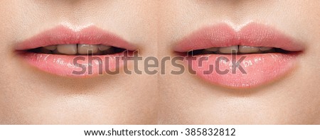 perfect lip injections