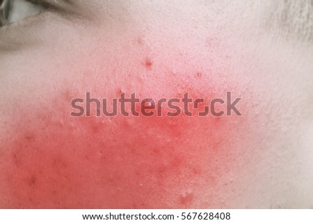 Acne treatment concept. Skin irritation, closeup