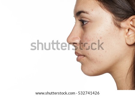 how to cure acne