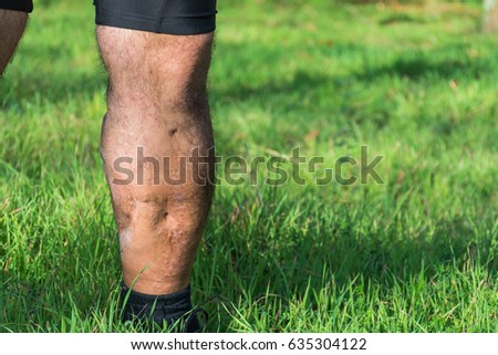 Scar-tissue Stock Images, Royalty-Free Images & Vectors | Shutterstock