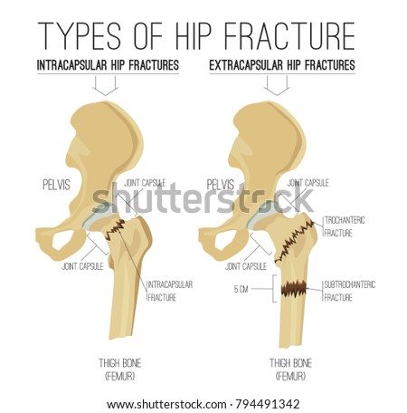 stock vector types of hip fracture non displaced intracapsular extracapsular trochanteric and subtrochanteric 794491342