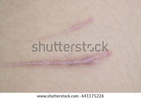 skin scar stock images royalty free images vectors scars stock images royalty free images vectors skin scar stock images royalty free images vectors scars stock images royalty free images vectors