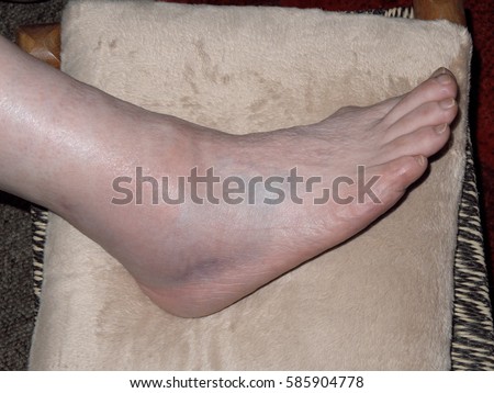 Bruised Swollen Sprained Ankle Stock Photo 585904778 - Shutterstock