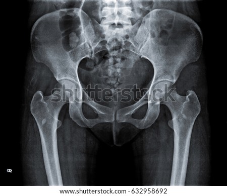 Xray Pelvis Spinal Column Woman Stock Photo 243407335 - Shutterstock