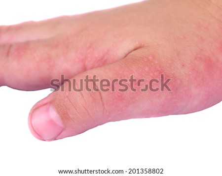 Eczema Stock Photos, Images, & Pictures | Shutterstock