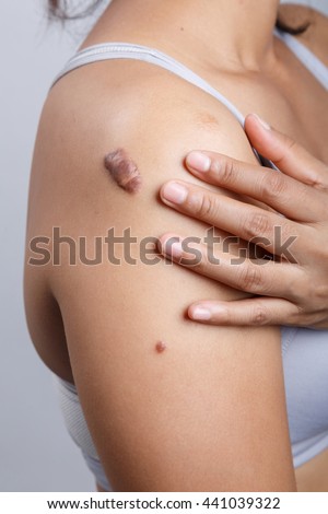 scar on human skin stock photo 121658896 scar on human skin keloid on stock photo 440378053 scar on human skin stock photo 121658896 scar on human skin keloid on stock photo 440378053