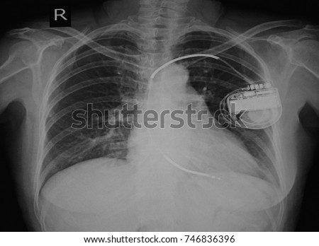 Defibrillator Vs Pacemaker Chest X Ray