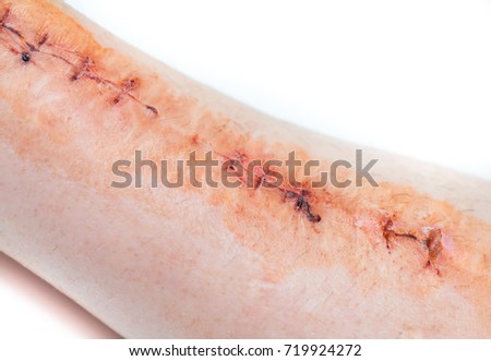 Appendicitis Scar Stock Images, Royalty-Free Images & Vectors ...