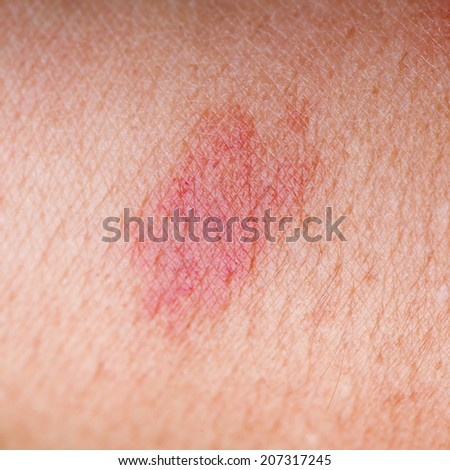 Red Birthmark Stock Photo 207317245 - Shutterstock