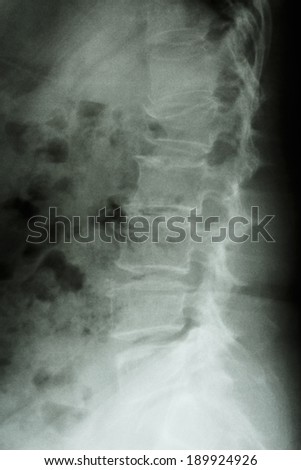 Lumbar Stock Photos, Images, & Pictures | Shutterstock