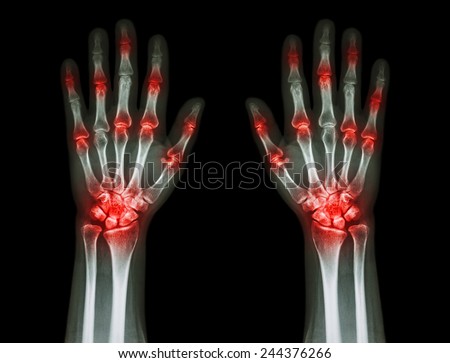 Rheumatoid Arthritis Gout Arthritis Film Xray Stock Photo 324020888 ...