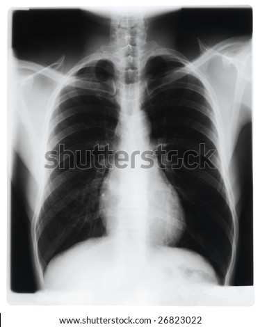 Smoker Lung Stock Photos, Images, & Pictures | Shutterstock