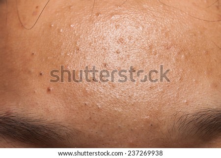 stock photo pimple blackheads on the forehead of a teenager 237269938