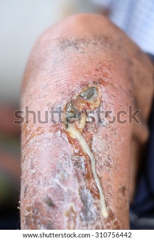 reflection leg ulcers This is a chronic leg ulcer what causes leg ulcers the most common underlying problem causing chronic leg ulcers is disease of the veins of the leg venous disease is the main reason for over two thirds of all leg ulcers venous disease. reflection leg ulcers This is a chronic leg ulcer what causes leg ulcers the most common underlying problem causing chronic leg ulcers is disease of the veins of the leg venous disease is the main reason for over two thirds of all leg ulcers venous disease.