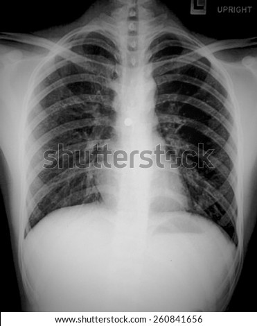 Chest Xray Stock Photo 62282371 - Shutterstock