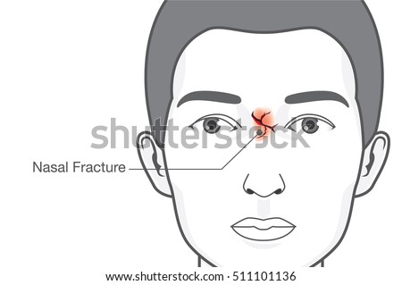 Contusion Stock Images, Royalty-Free Images & Vectors | Shutterstock