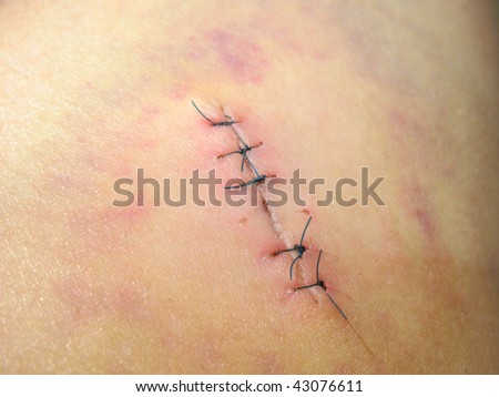 Stitches Skin Stock Images, Royalty-Free Images & Vectors | Shutterstock