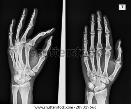 Normal Left Hand Oblique Position Xray Stock Photo 168137840 - Shutterstock