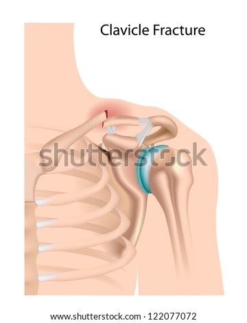 Shoulder Impingement Common Sport Injury Stock Illustration 89144563