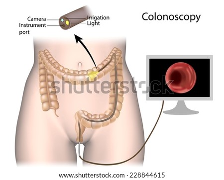 colonoscopy procedure labeled stock illustration 228844615