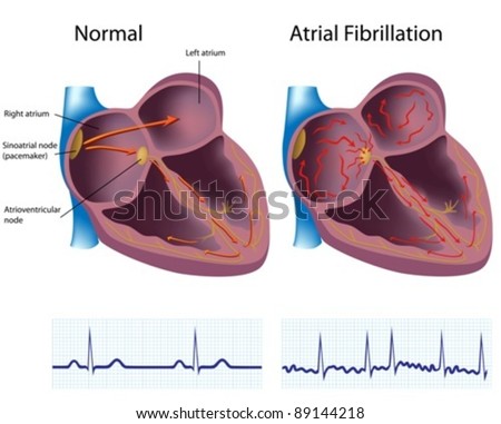 atrial fibrillation research paper New research paper atrial fibrillation (af) classifications that are used to recommend treatment decisions are based on af episode duration however, a number of observations suggest that within classification categories, af is a structurally and electrically diverse arrhythmia. atrial fibrillation research paper New research paper atrial fibrillation (af) classifications that are used to recommend treatment decisions are based on af episode duration however, a number of observations suggest that within classification categories, af is a structurally and electrically diverse arrhythmia.