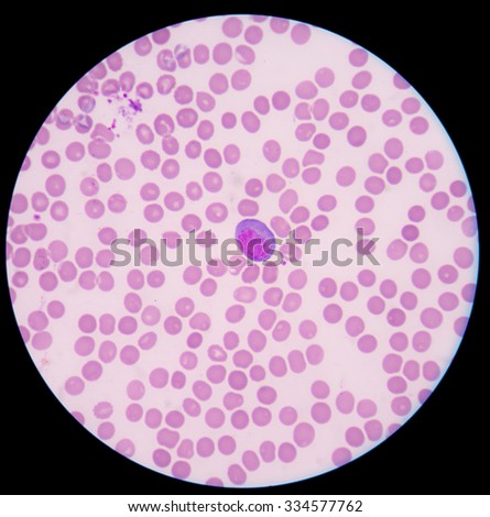 Blood Films Dengue Fevershowing Atypical Lymphocyte Stock Photo ...