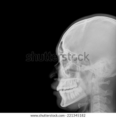 Film Xray Skull Lateral Show Normal Stock Photo (Royalty Free ...