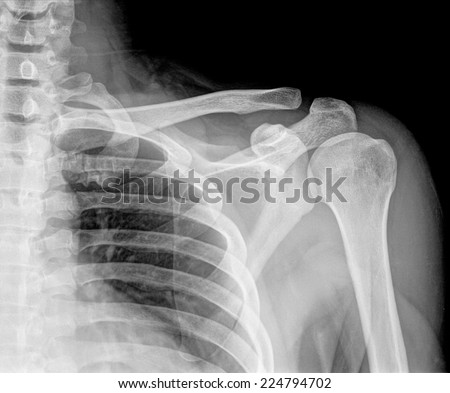 X-ray of Left human shoulder with hold 5 Kg, A C joint - stock photo