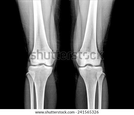 Collection Xray Normal Knee Stock Photo 73834516 - Shutterstock