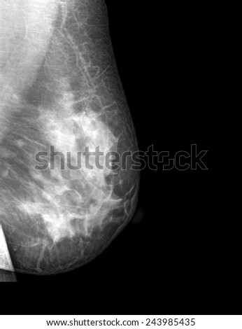 Mri breast cancer diagnosis And have Believe, Mri breast cancer diagnosis excellent