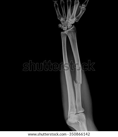 Xray Arm Stock Images, Royalty-Free Images & Vectors | Shutterstock