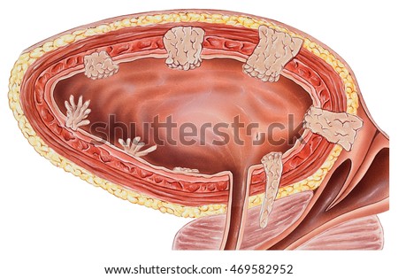 Bladder Stock Images, Royalty-Free Images & Vectors ... bladder wall diagram 